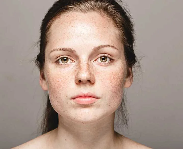 Pigmentation Treatment in Delhi